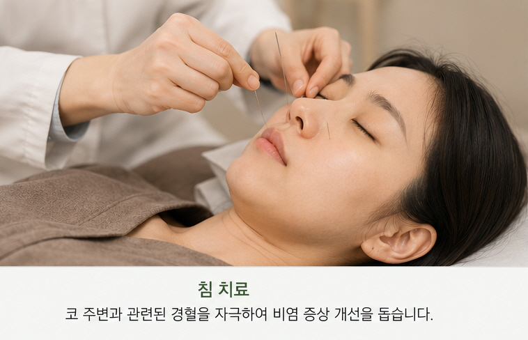 비염 증상과 관련해 코 주변에 침 치료를 하는 모습